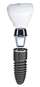 North Ogden Dental Implants