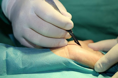 Chi phí phẫu thuật điều trị hội chứng ống cổ tay