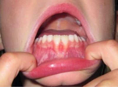mamelon gigi kekal