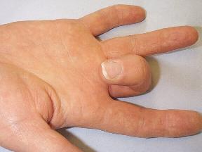 Biểu hiện điển hình của ngón tay bật (ngón tay lò xo)