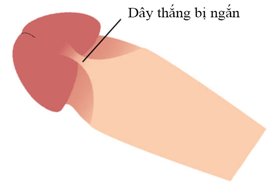 Dương vật bị cong xuống dưới khi cương Duong-vat-bi-cong-xuong-duoi-khi-cuong
