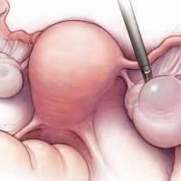 Ovarian Cyst Pain Relief post image