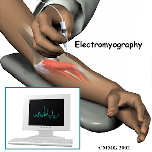 Đo điện cơ chẩn đoán chính xác hội chứng ống cổ tay và giúp loại trừ những bệnh lý khác