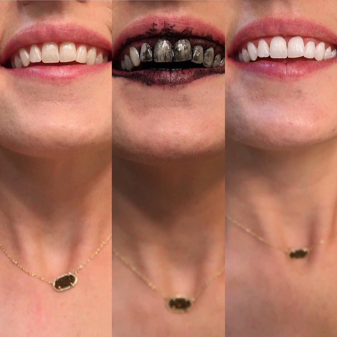 Bột trắng răng than hoạt tính Procoal