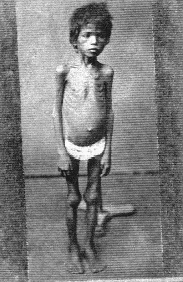 Uma criança magra pela fome que fora causa pela grande seca.