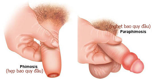 Bán hẹp bao quy đầu dẫn đến nghẹt bao quy đầu Bán hẹp bao quy đầu dẫn đến nghẹt bao quy đầu