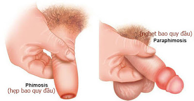 Hẹp bao quy đàu và nghẹt bao quy đầu Hep-bao-quy-dau-va-nghet-bao-quy-dau