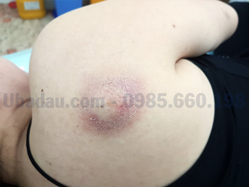 U bã đậu ở vai nhiễm trùng