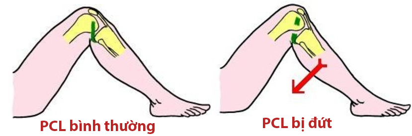 Minh hoạ dây chằng chéo sau bình thường và khi bị đứt