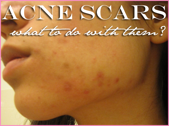 Wat te doen bij acné littekens? ⋆ Beautylab.nl