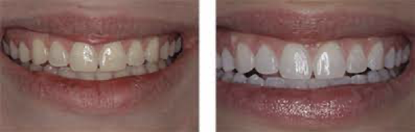 Teeth whitening colorado springs