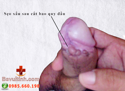 Sẹo xấu sau cắt bao quy đầu seo-xau-sau-cat-bao-quy-dau