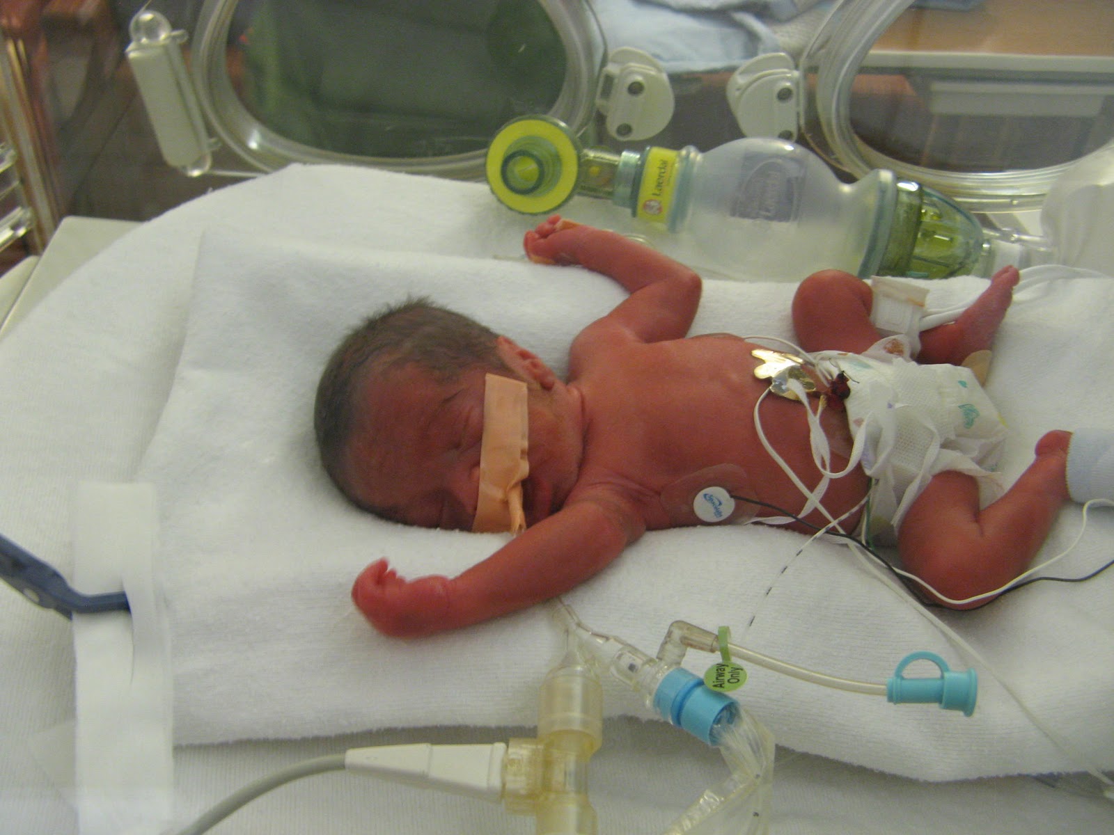 Preemie um Six Weeks Ago 