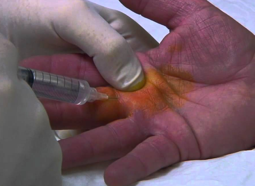 Chích thuốc gây tê gốc ngón để tiểu phẫu ngón tay cò súng