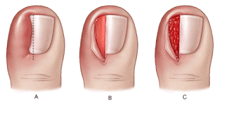 các bước tiểu phẫu móng chọc thịt