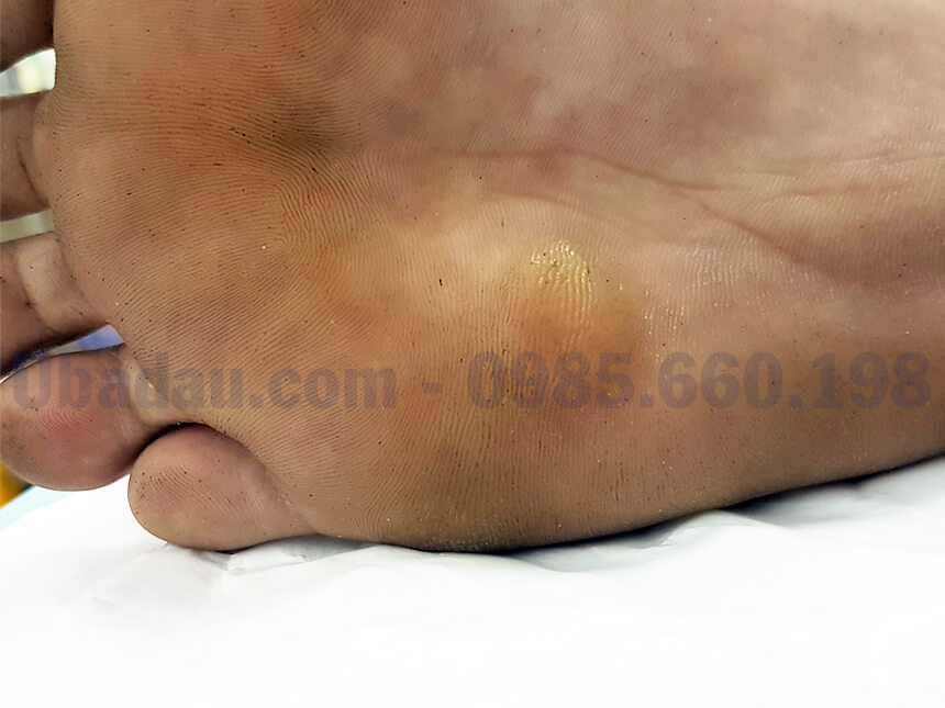 U bã đậu ở lòng bàn chân