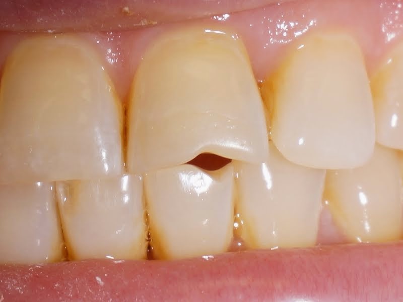 Необычные дефекты зубов. 