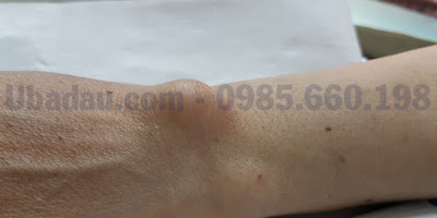 U BAO HOẠT DỊCH CỔ TAY-NGUYÊN NHÂN VÀ CÁCH CHỮA TRỊ HIỆU QUẢ