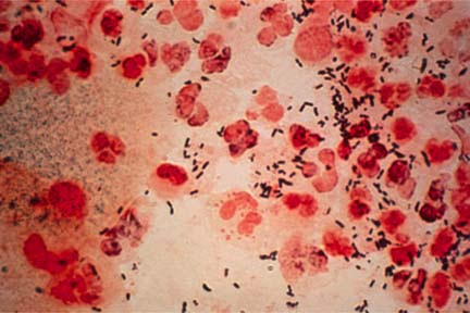 bakteri Neisseria gonorhoeae, penyebab penyakit gonore