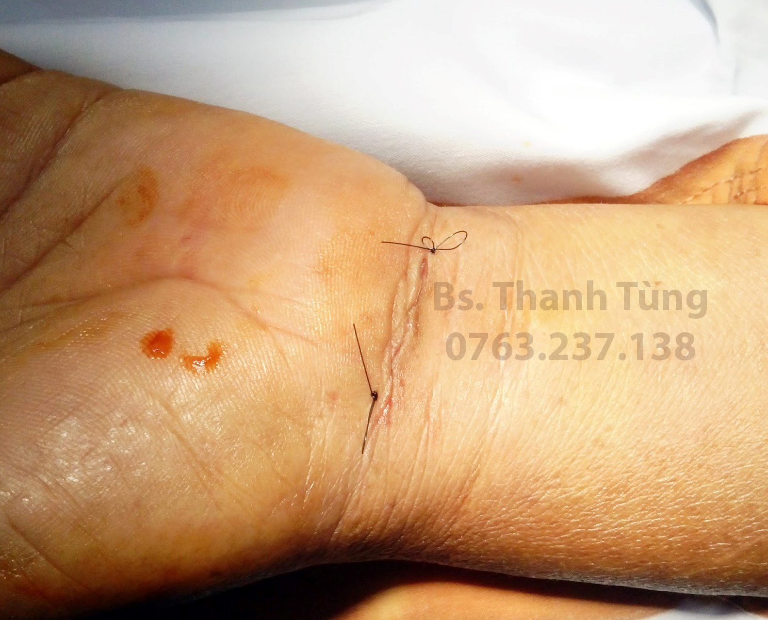 Hình ảnh vết mổ hội chứng ống cổ tay sau khi vừa khâu lại Hình ảnh vết mổ hội chứng ống cổ tay sau khi vừa khâu lại