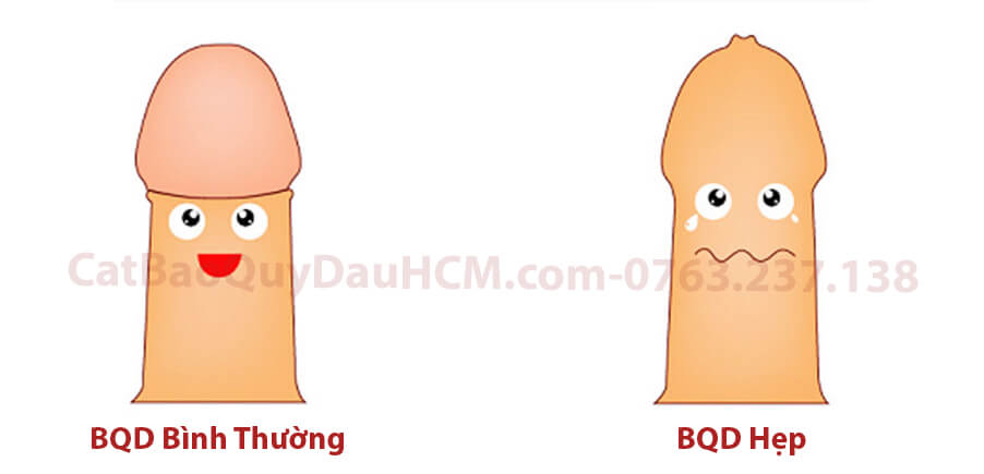 Hình ảnh bao quy đầu bị hẹp và bao quy đầu bình thường