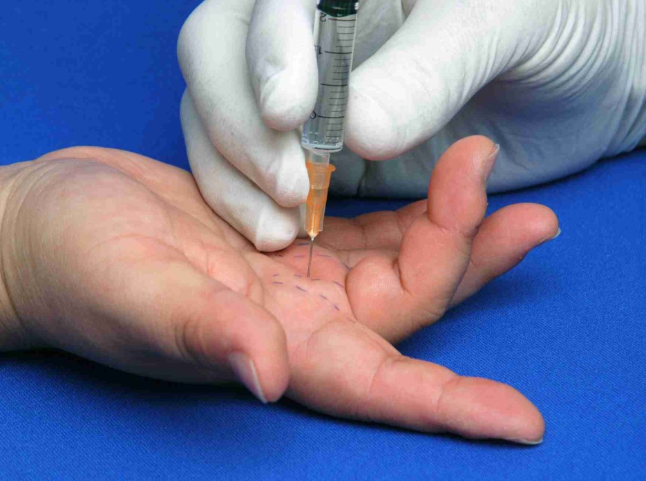 Tiêm thuốc kháng viêm tại chỗ trong điều trị ngón tay lò xo