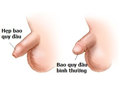 Hình ảnh bao quy đầu bị hẹp và bao quy đầu bình thường Hinh-anh-bao-quy-dau-bi-hep-va-bao-quy-dau-binh-thuong