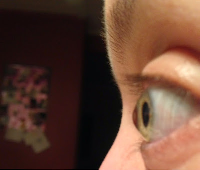 Close-up side view of keratoconus eye.