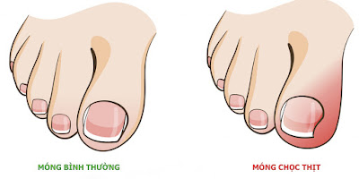 THÔNG TIN VỀ BỆNH MÓNG CHỌC THỊT BẠN CẦN BIẾT