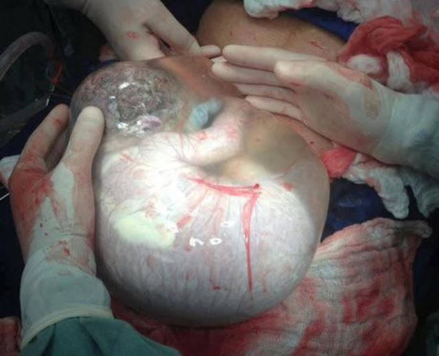 Bebé nace por cesárea sin que se rompa la bolsa