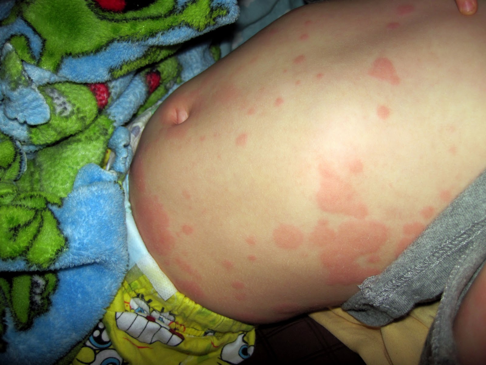 Learning to make lemonade....: Hives Are Horrible!!!