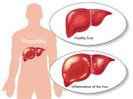 mengobati hepatitis dengan cara alami
