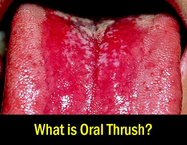 Oral-Thrush