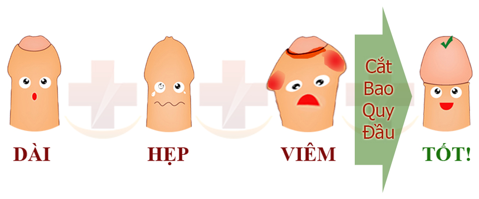 Viêm bao quy đầu nguyên nhân chủ yếu là do hẹp và dài bao quy đầu