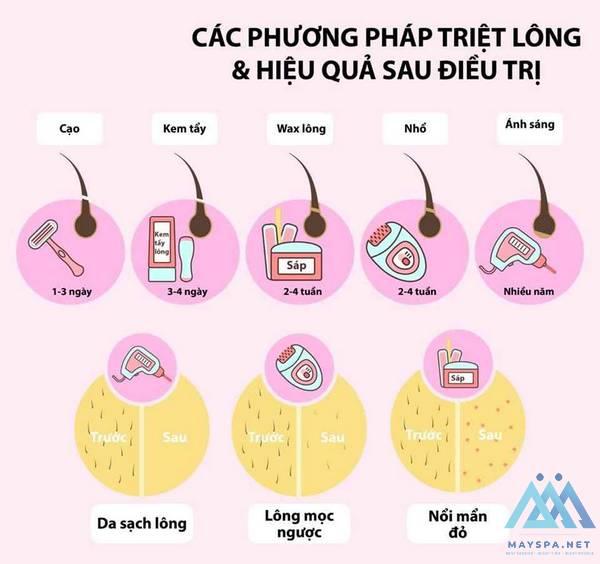 quy-trinh-triet-long-2-mtmi
