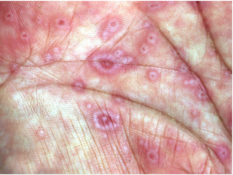 Cutaneous Infections
