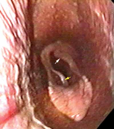 Exercising videoendoscopic examination of a 4-yr-old Thoroughbred gelding with moderate resting arytenoid abduction.