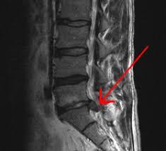 Spinal disc herniation - Wikipedia