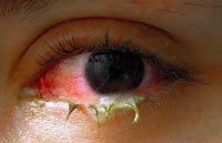 What is Pink eye (conjunctivitis)