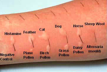 Clinical Interpretation of Allergy Skin Testing