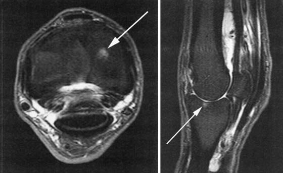 This is a sagittal and an axial STIR image from a horse with an osteochrondral lesion in the proximal P-1.
