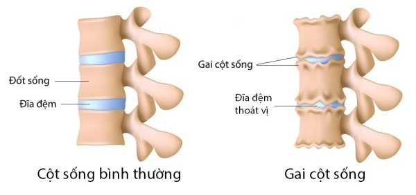 Cột sống bị gai xương