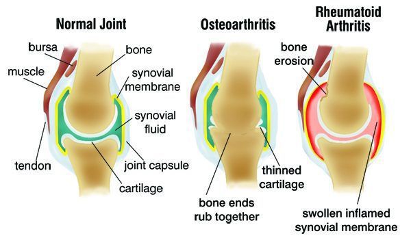 arthritis types
