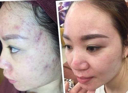 hiệu quả trị mụn hoàn mỹ đan