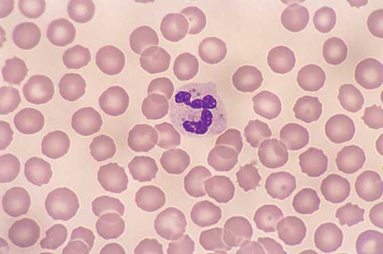 Canine distemper inclusion bodies. Pale light pink, round cytoplasmic droplets in the neutrophil are canine distemper viral inclusions (100x).