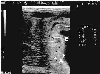 Transabdominal and transrectal ultrasonography of the placenta in a mare during 9th month of gestation. The combined thickness of the uterus and placenta (A) is abnormal (11 mm), and the placenta is separated close to the cervix. The external border of the uterus is outlined by black spots, and the allantoic fluid (B) marks the internal border of the placenta.