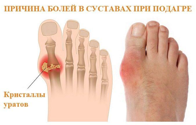 https://sustavlive.ru/wp-content/uploads/2016/07/chem-lechit-podagru-na-bolshom-palce-nogi.jpg