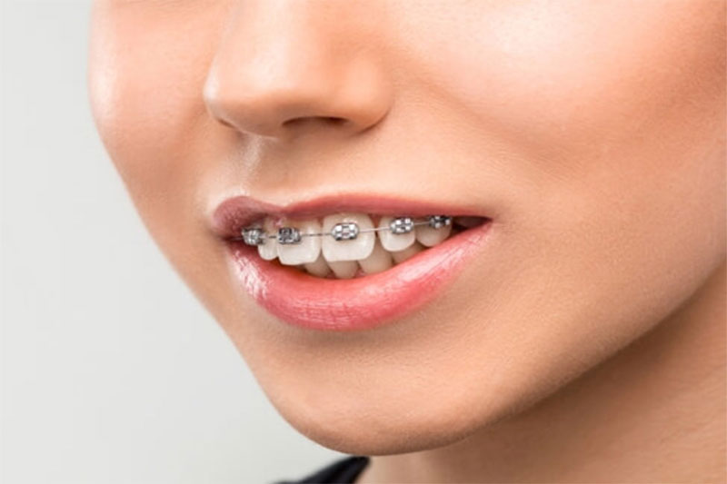 Niềng răng 1 hàm thực hiện với những sai lệch của răng ở 1 hàm duy nhất