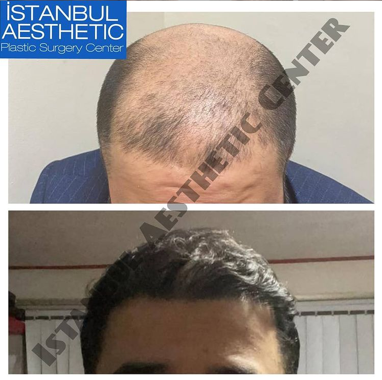 Top 10 Clinics for Hair Transplant in Turkey