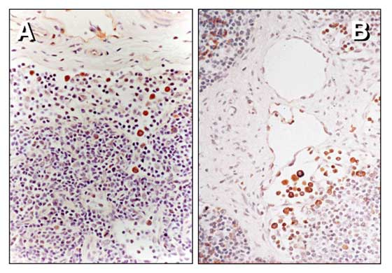 Técnica de coloración por inmunoperoxidasa para antígeno de HVE-1 en leucocitos mononucleares dentro del ganglio linfático submandibular de un caballo infectado.